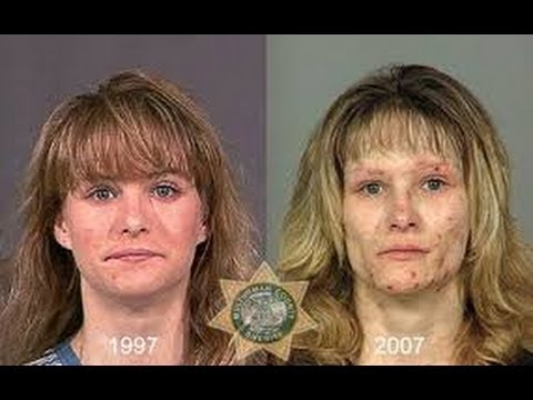 Crystal Meth: Before and After